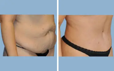 Before and After